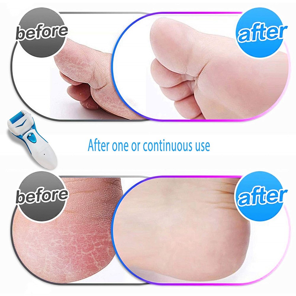 Electric callus remover foot file nursing foot grinder